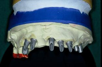 Implantatbrücke von Dr. Vangerow