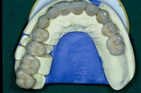 Implantatbrücke von Dr. Vangerow